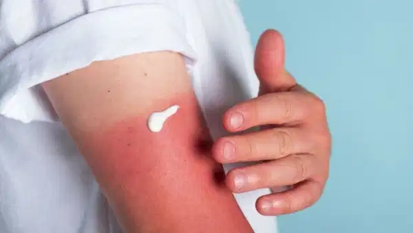 Güneş yanığı sonrası ne yapılmalı? İşte cildi rahatlatan pratik bakım önerileri